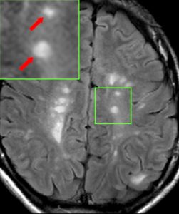 Neuro-inflammatory disorders